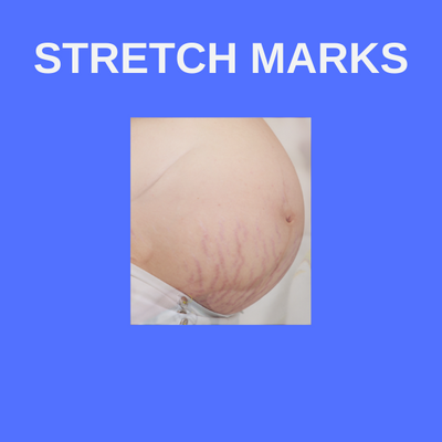 Baby Stretch Marks (Moroccan Argan Oil)