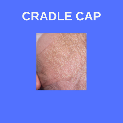 Baby Cradle Cap - Foaming Hair & Body Wash (Fragrance Free)
