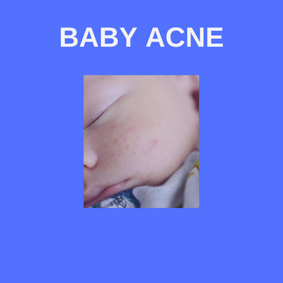 Baby Acne Wash (Fragrance Free)